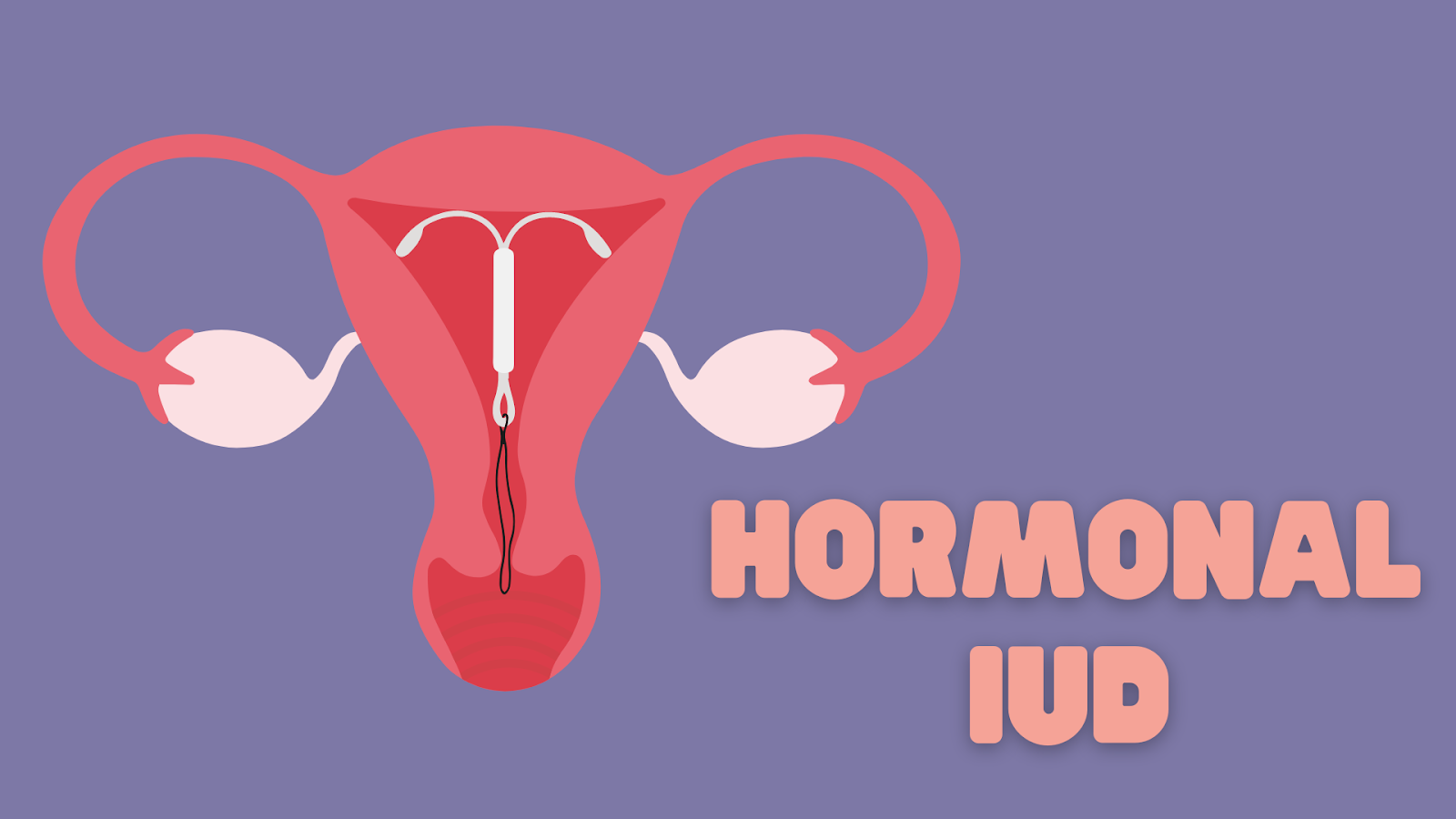 hormonal-iud